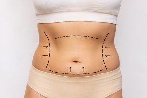 tummy tuck