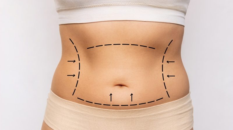 tummy tuck