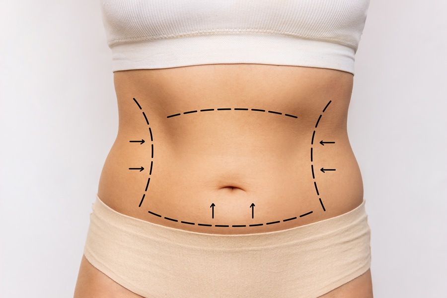 tummy tuck